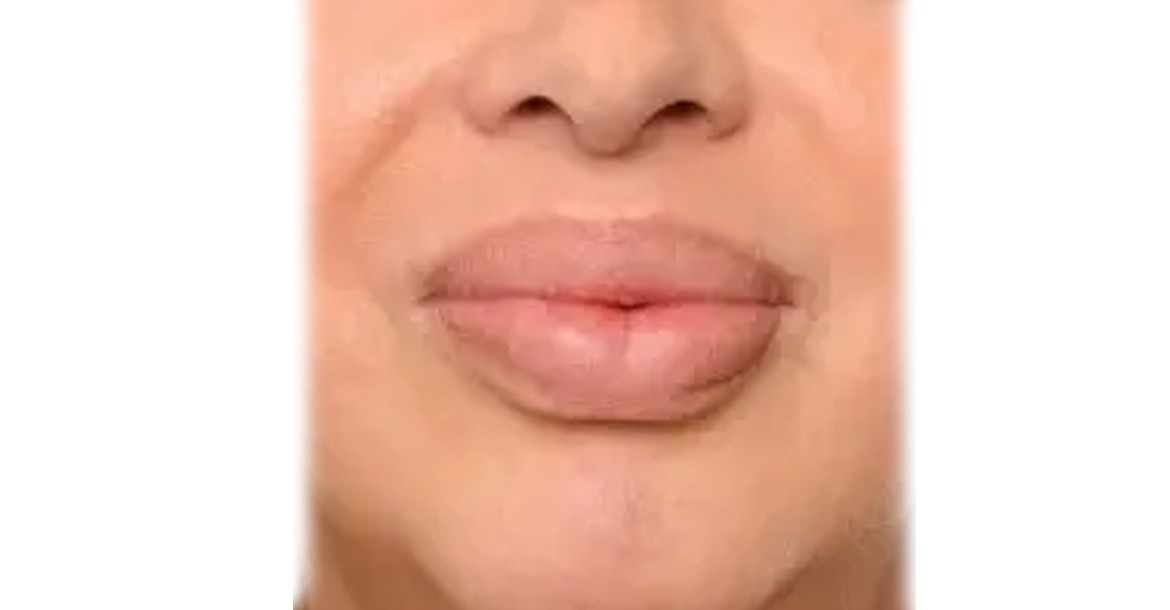 Lip Reduction Surgery in Hyderabad
