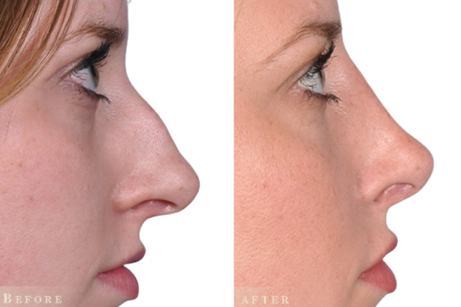 Nose Reconstruction