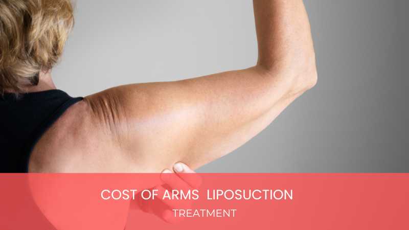 Cost of Arms Liposuction Treatment