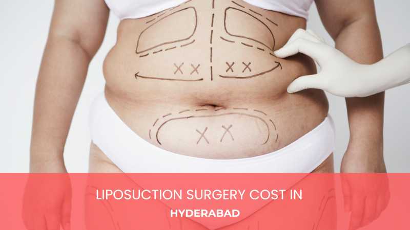 Liposuction Surgery Cost