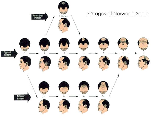 Norwood Scale