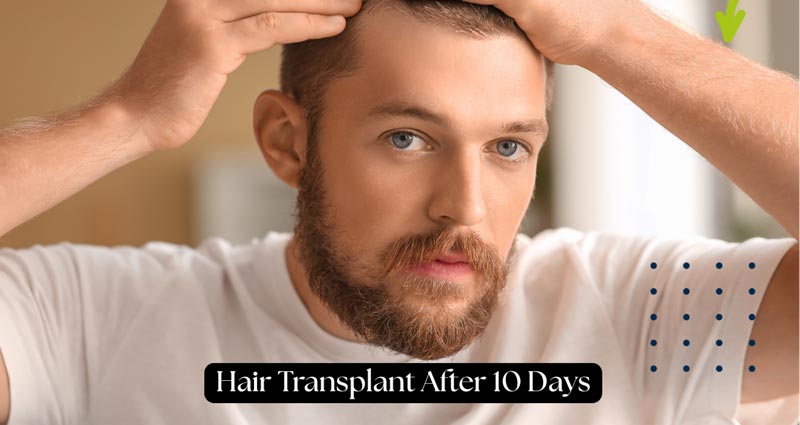 Hair Transplant 10 Days
