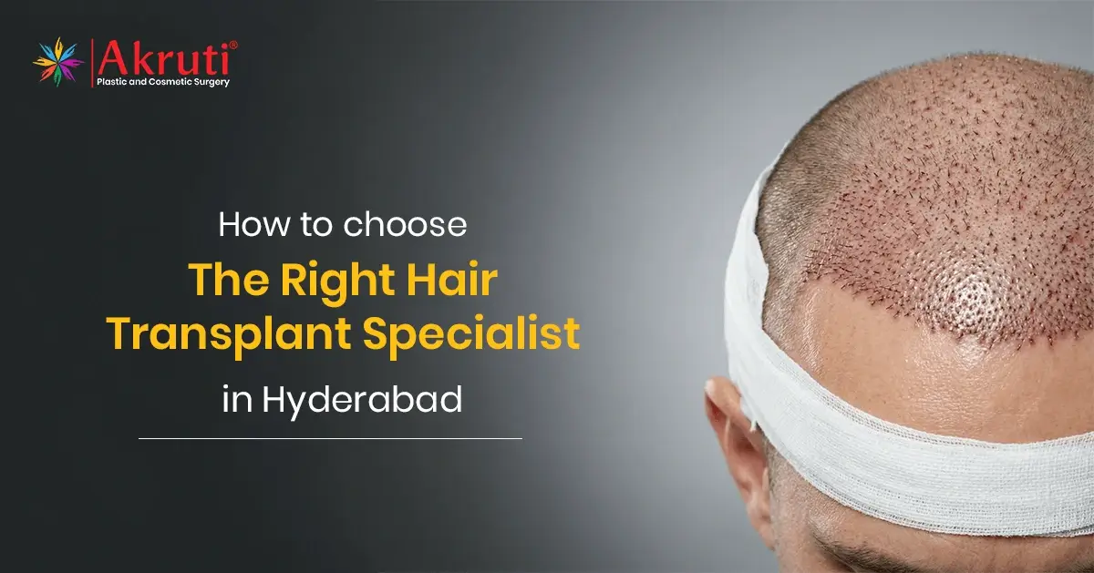 How to Choose the Right Hair Transplant Specialist in Hyderabad?