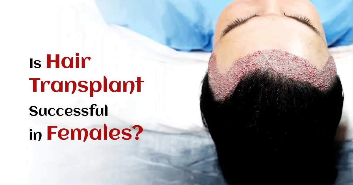 Is Hair Transplant Successful in Females?