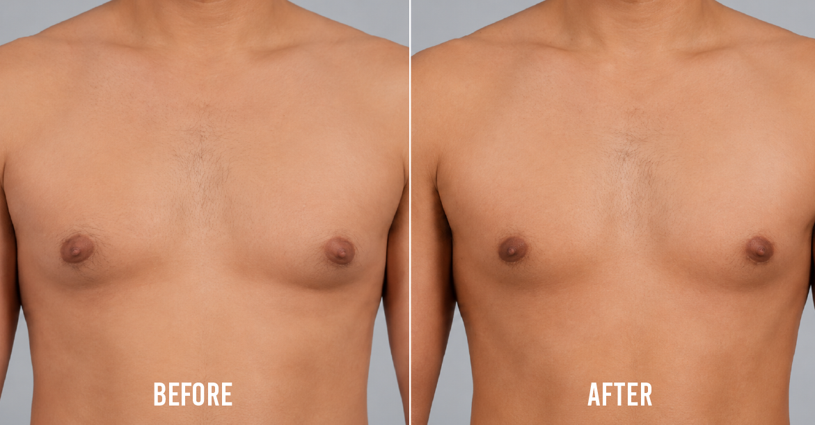 Gynecomastia Surgery